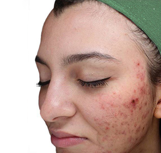 face before using our products, Full with Acne and marks.