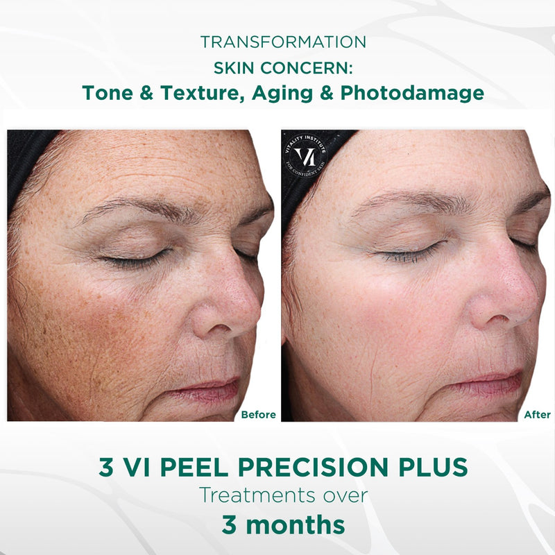 VI Peel Precision Plus Professional Treatment