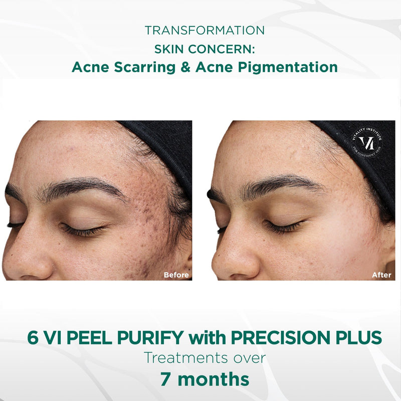 VI Peel Purify With Precision Plus Professional Treatment