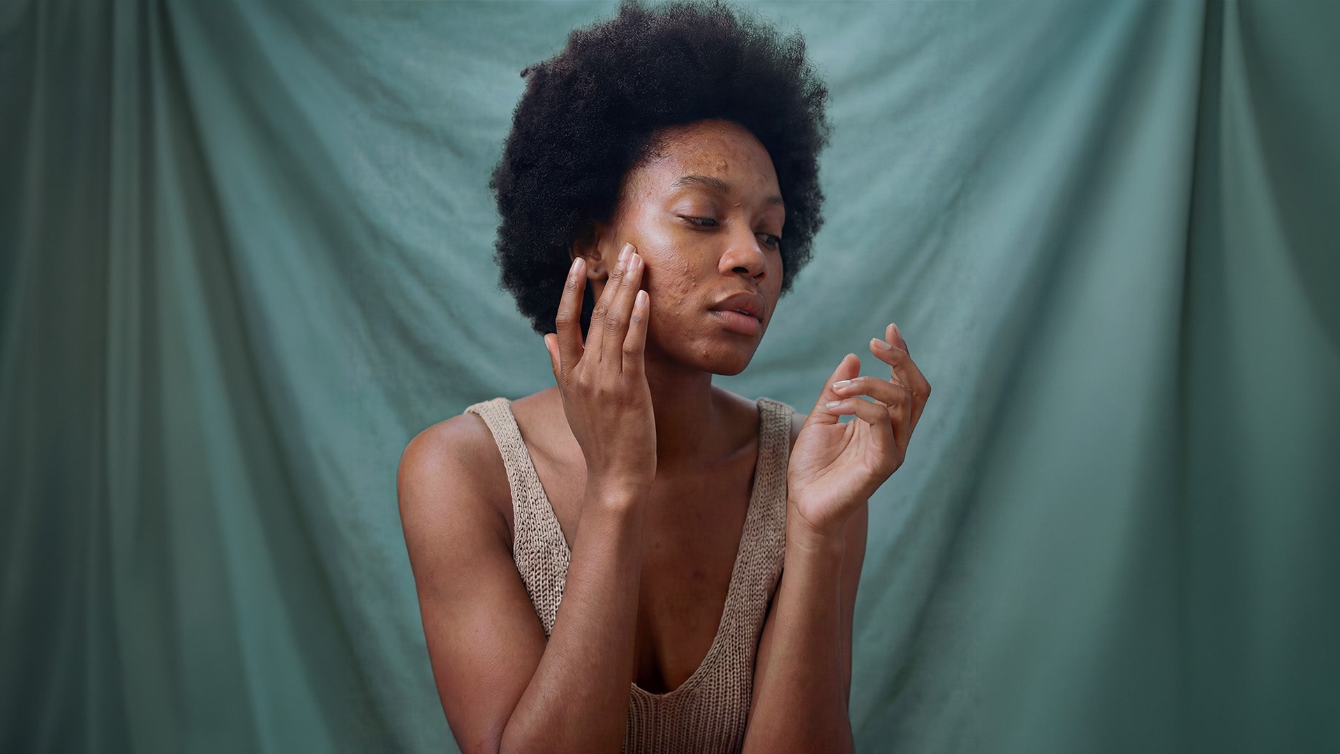 Acne Scaring - Skin of Color – VI Derm