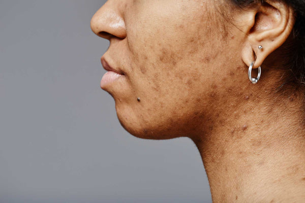 Acne Scaring - Skin of Color