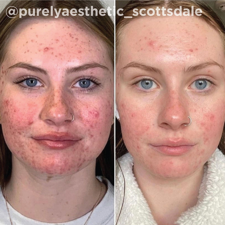 VI Peel before and after result 1