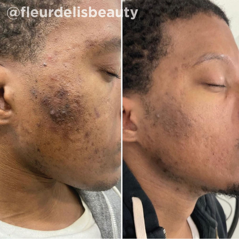 VI Peel before and after result 2