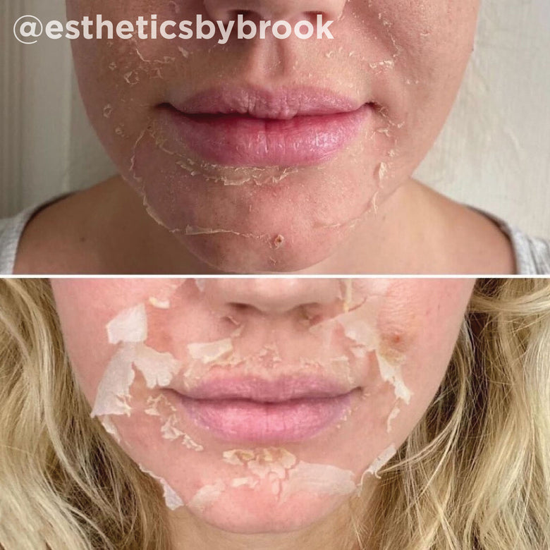 VI Peel before and after result 3