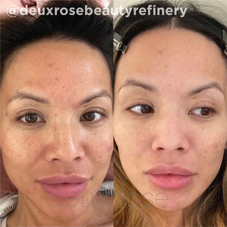 VI Peel before and after result 4