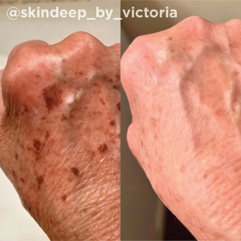 VI Peel before and after result 5