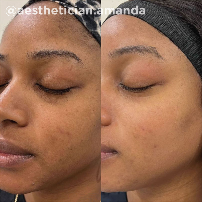 VI Peel before and after result 6