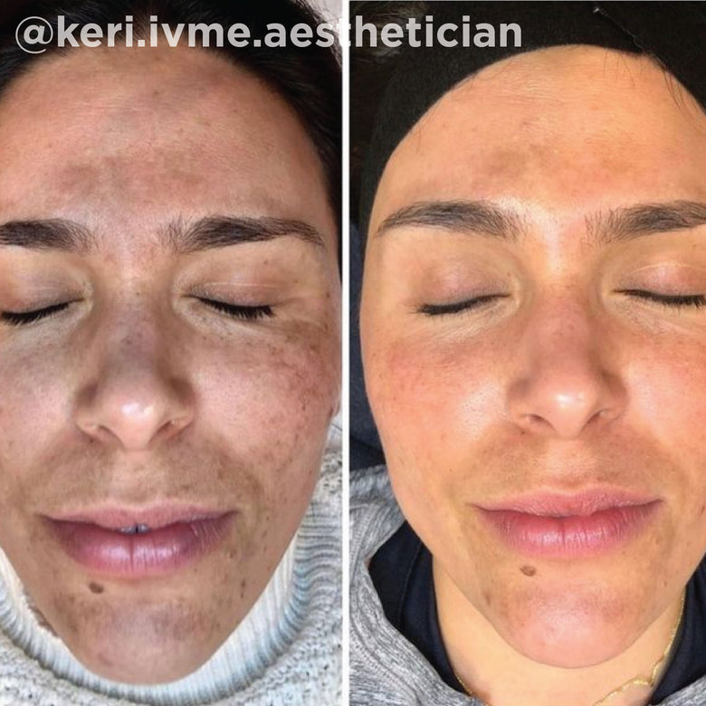 VI Peel before and after result 7