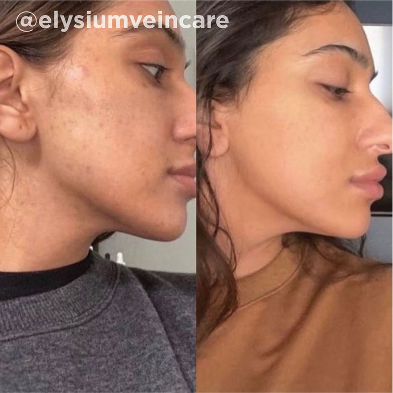 VI Peel before and after result 8