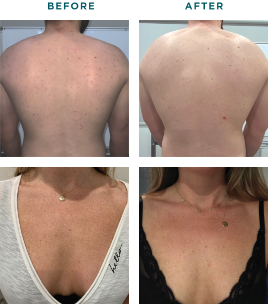 Body Chemical Peels