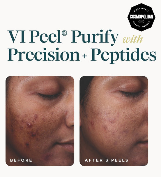 VI Peel Purify with Peptides before and after