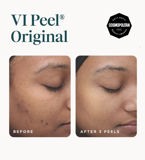 VI Peel Original before and after