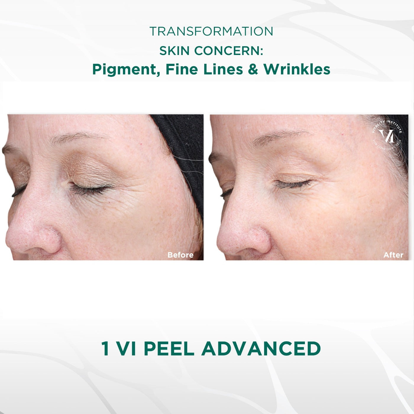 Vi Peel Near Me – Get Glowing Skin with Convenient Treatments Vi Peel Near Me – Get Glowing Skin with Convenient Treatments