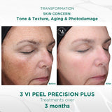 VI Peel Precision Plus Professional Treatment