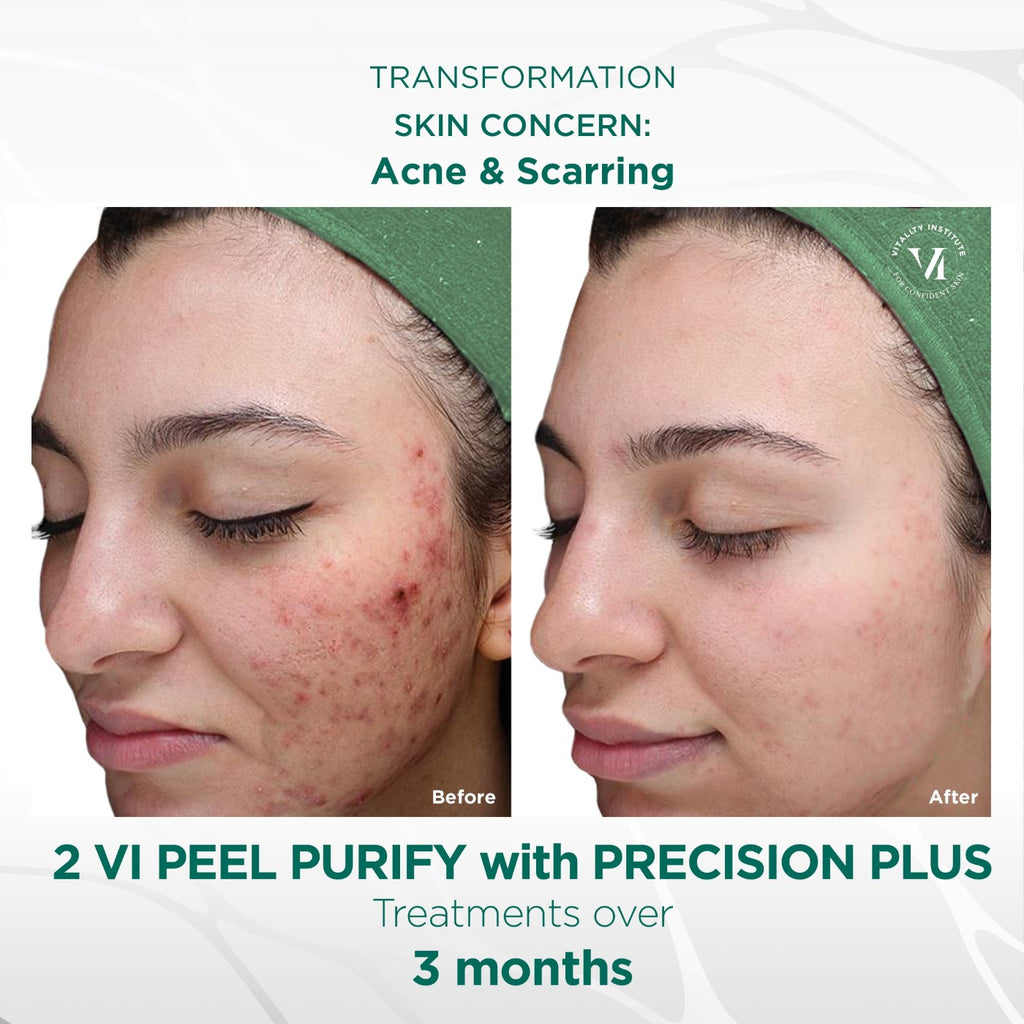 VI Peel Purify With Precision Plus Professional Treatment – VI Derm